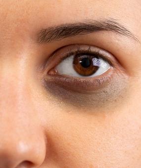 how to get rid of eye Dark Circles